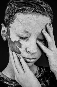 ニキビ跡の色素沈着に効果的な刺激少なめ化粧水の選び方は？