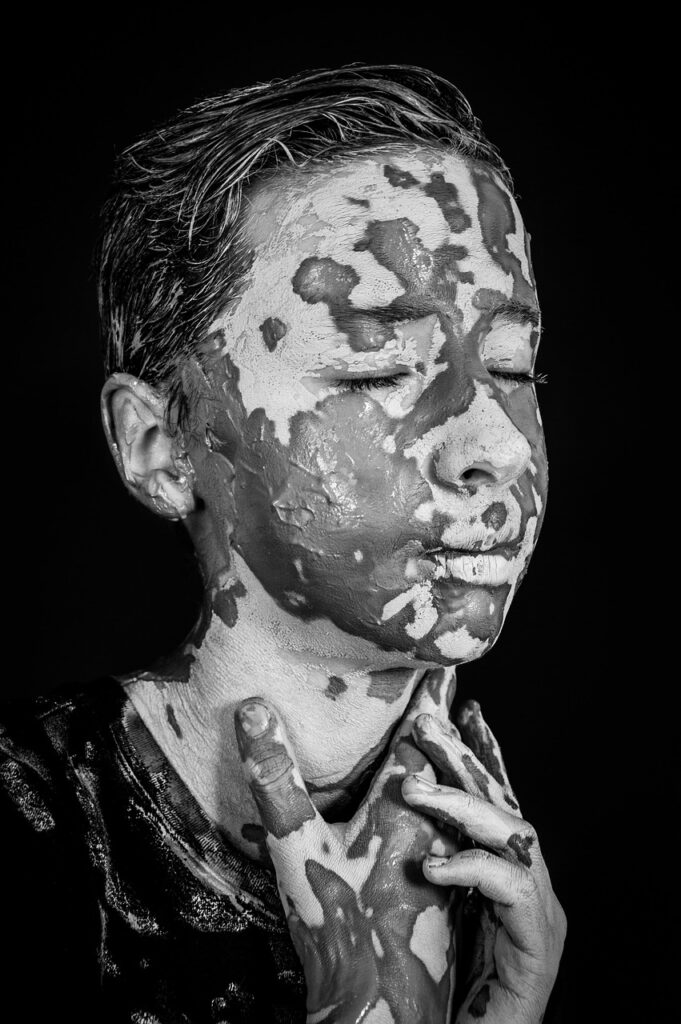 ニキビ跡の色素沈着に効果的な医薬部外品ローションランキングは？